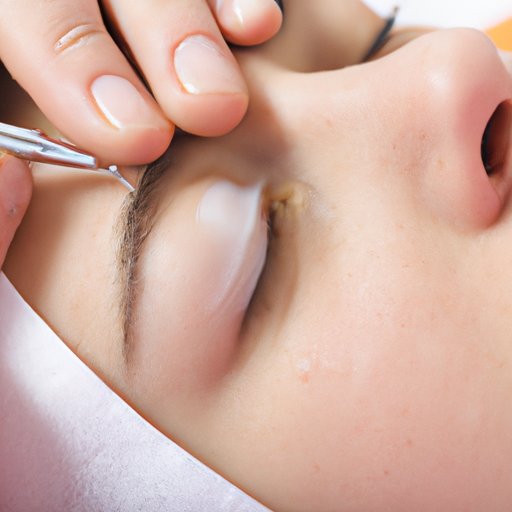 Use of a Sterile Needle to Remove Eye Skin Tags