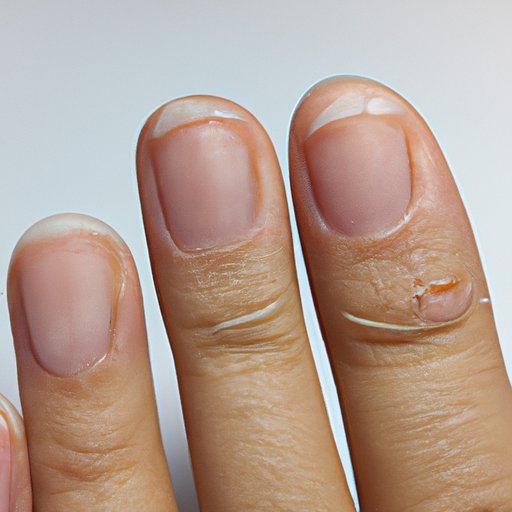 Definition of Skin Peeling on Fingers Near Nails