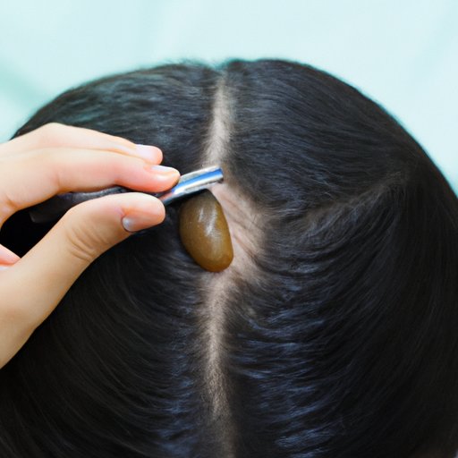 Diagnosing and Treating Alopecia Areata