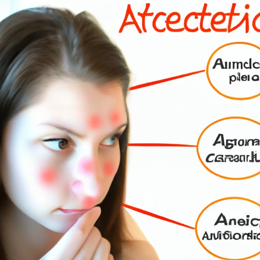 Investigating the Correlation Between Hormonal Changes and Acne