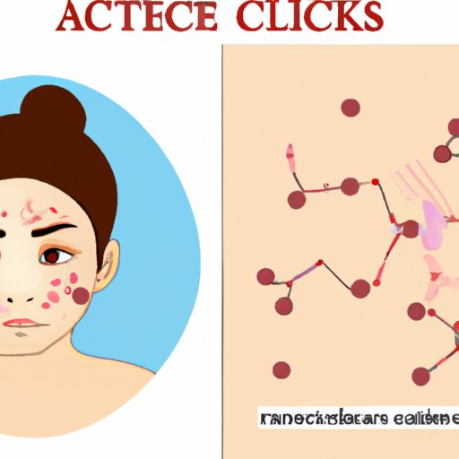 Investigating the Relationship Between Stress and Cheek Acne
