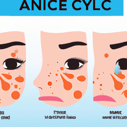 Crying and Its Effects on Acne
