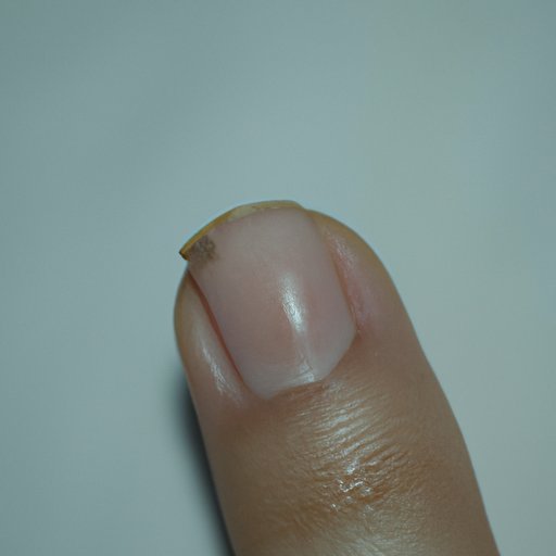 Common Types of Nail Fungus and What They Look Like