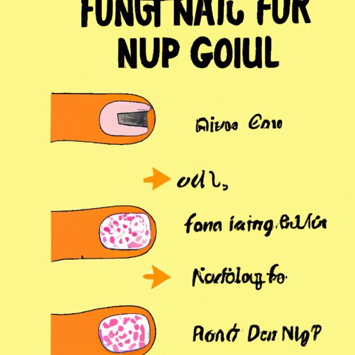 How to Spot Nail Fungus: A Picture Guide