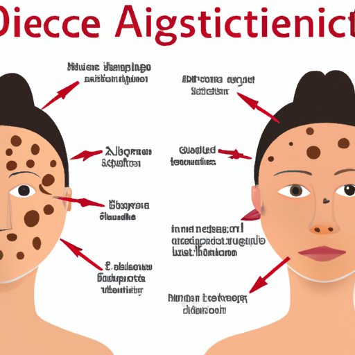 Understanding When Acne Is Likely to Disappear