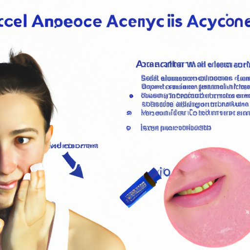 Understanding the Benefits of Exercise for Reducing Itchy Acne