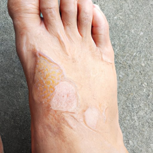 Causes of Peeling Skin on Feet