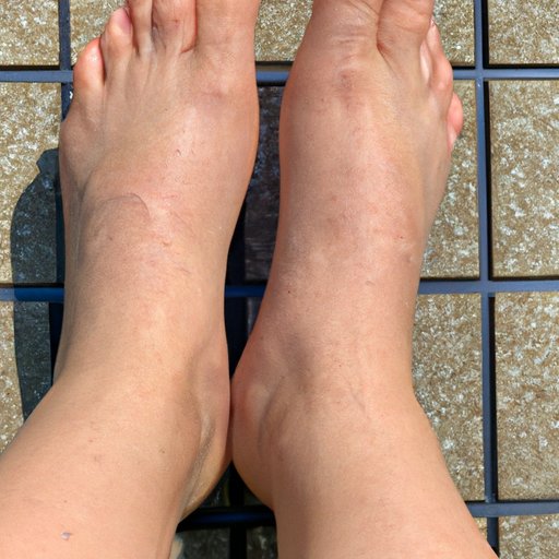 Overview of Peeling Skin on Feet