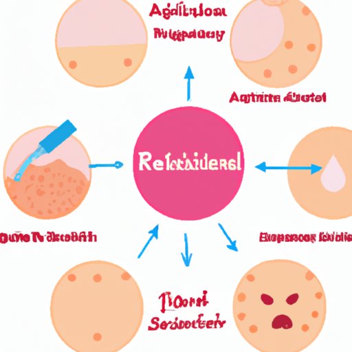 Do Retinoids Help Acne? A Comprehensive Guide to Retinoid Therapy