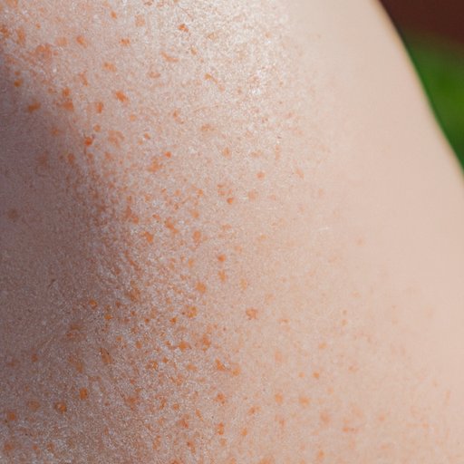 What Causes Moles on Skin? A Comprehensive Guide