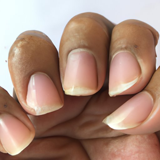 What Causes Nail Ridges? Exploring the Risk Factors and Common Causes