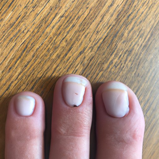 Nail Fungus: What Does It Look Like and How Can You Treat It?