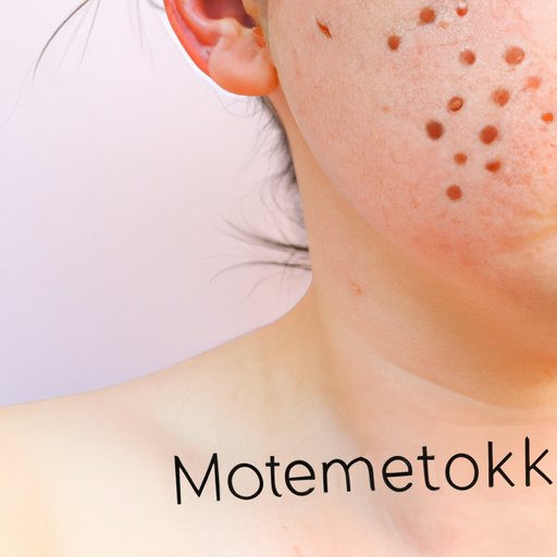 What is Mottling of the Skin? Causes, Symptoms and Treatment