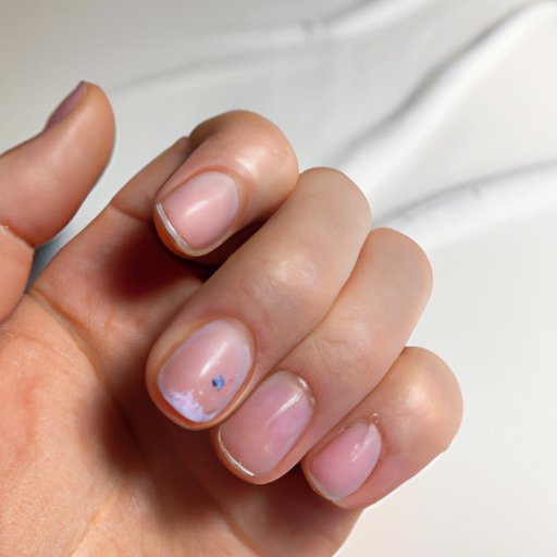 What is Nail Pitting? Overview, Symptoms, Causes and Treatments