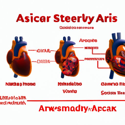 The Most Common Cause of Abdominal Aortic Aneurysm: Exploring Atherosclerosis