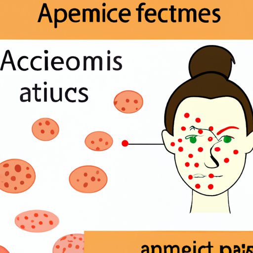 Exploring Why Do I Have Acne on My Cheeks?